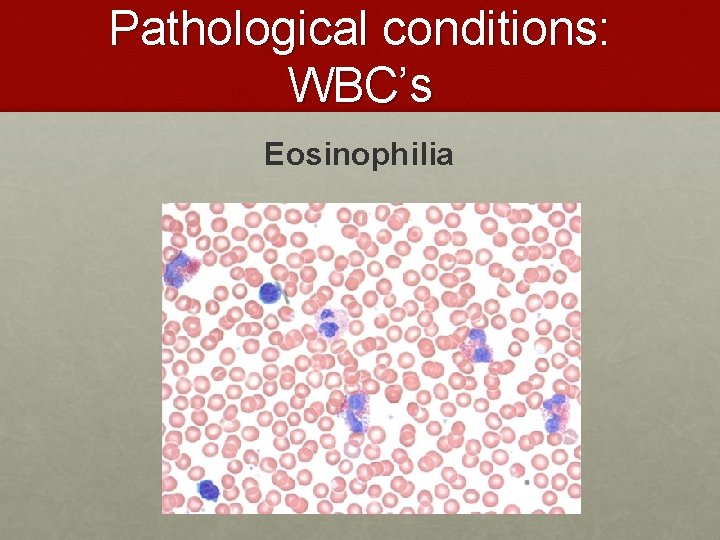Pathological conditions: WBC’s Eosinophilia Pathological conditions: WBC’s Eosinophilia