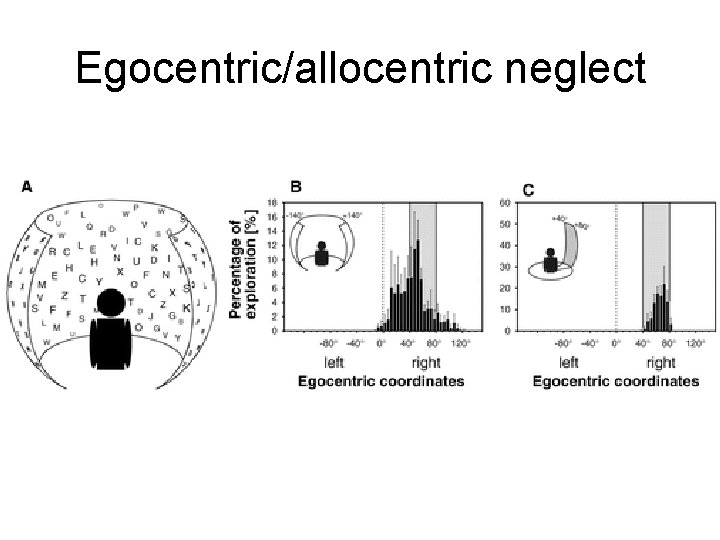 Egocentric/allocentric neglect 