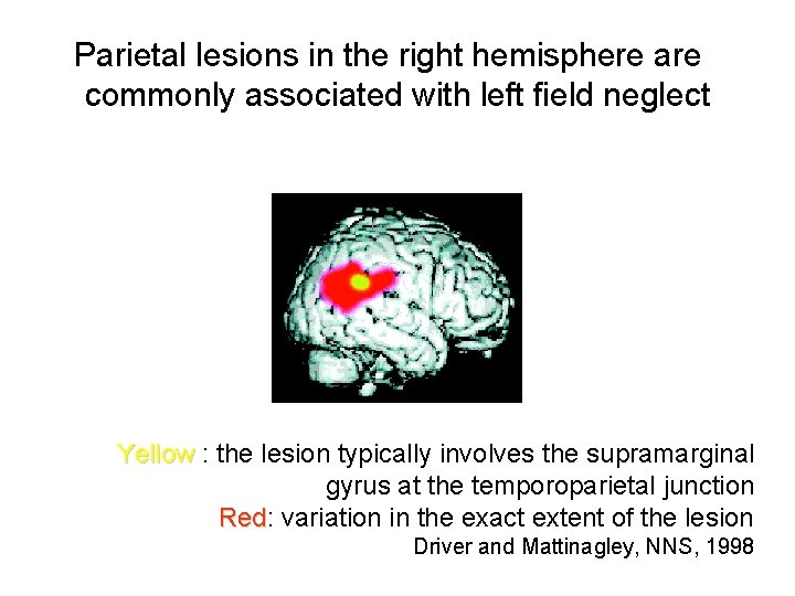 Parietal lesions in the right hemisphere are commonly associated with left field neglect Yellow