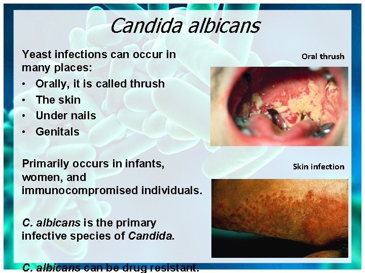 Candida albicans Yeast infections can occur in many places: • Orally, it is called