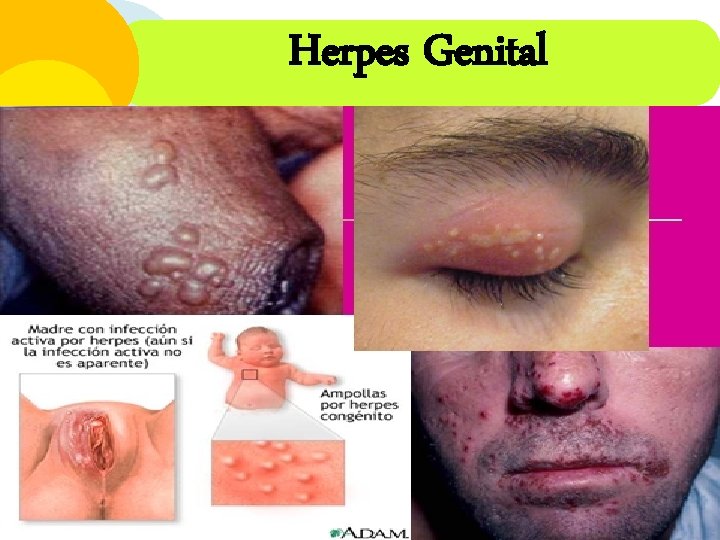 Herpes Genital 