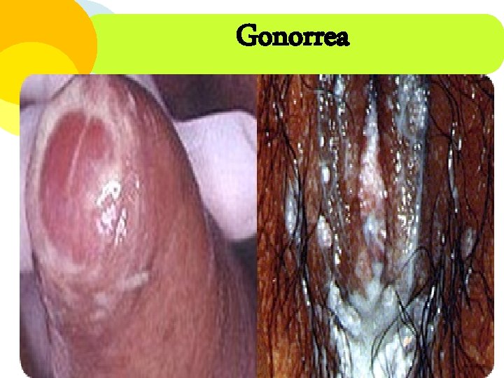 Gonorrea 