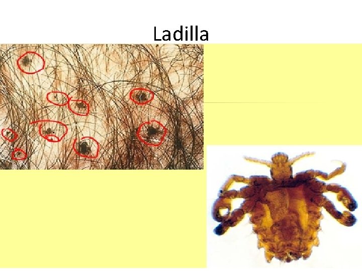 Ladilla 