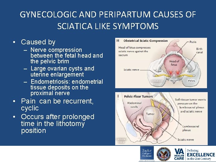 GYNECOLOGIC AND PERIPARTUM CAUSES OF SCIATICA LIKE SYMPTOMS • Caused by – Nerve compression