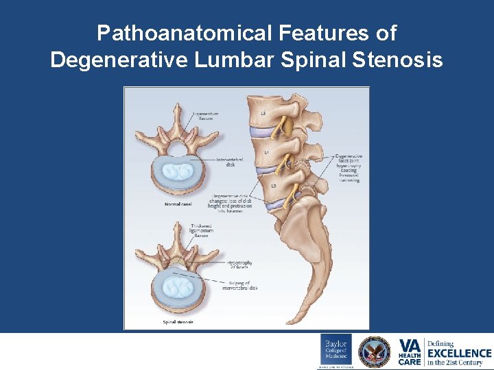 Pathoanatomical Features of Degenerative Lumbar Spinal Stenosis 