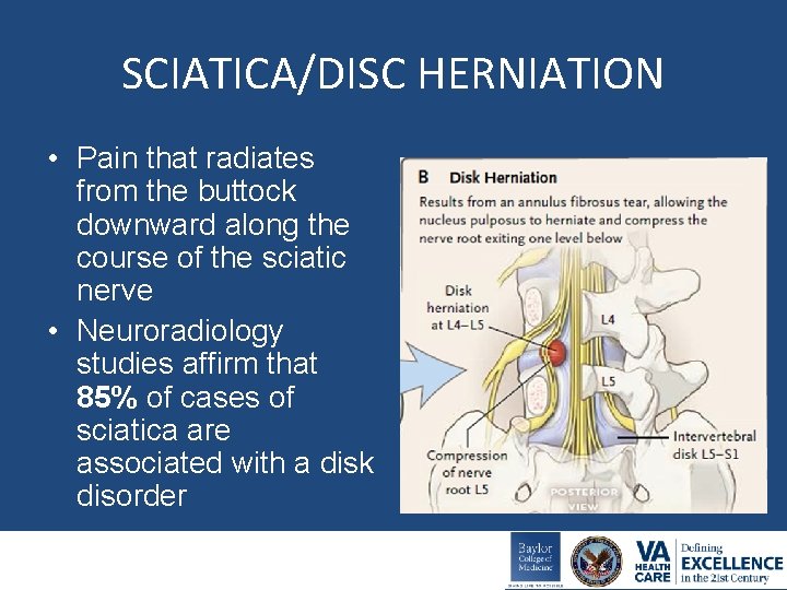 SCIATICA/DISC HERNIATION • Pain that radiates from the buttock downward along the course of