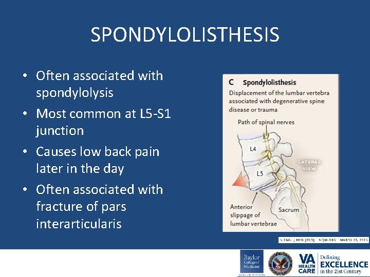 SPONDYLOLISTHESIS • Often associated with spondylolysis • Most common at L 5 -S 1