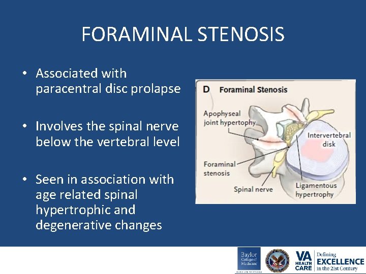 FORAMINAL STENOSIS • Associated with paracentral disc prolapse • Involves the spinal nerve below