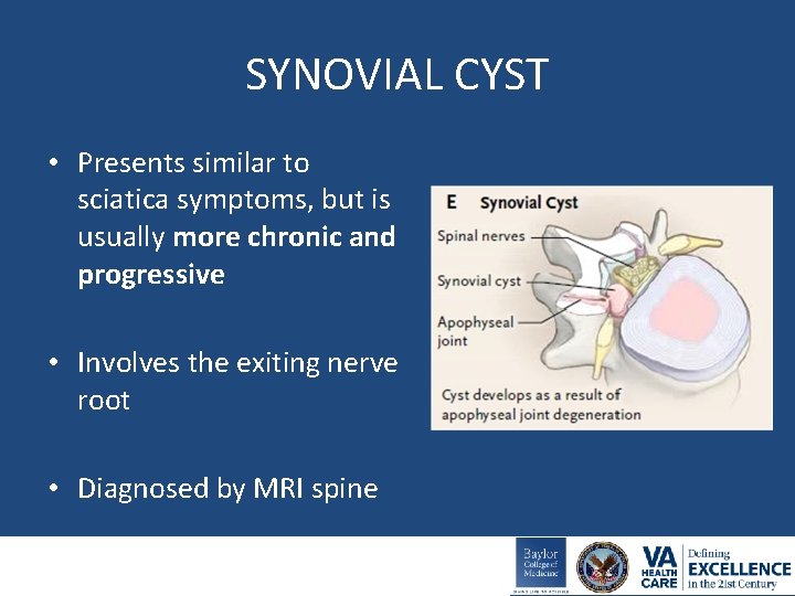 SYNOVIAL CYST • Presents similar to sciatica symptoms, but is usually more chronic and