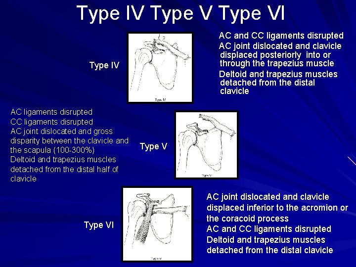 Type IV Type VI AC and CC ligaments disrupted AC joint dislocated and clavicle