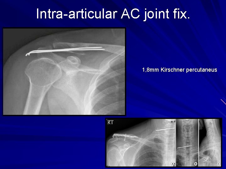 Intra-articular AC joint fix. 1, 8 mm Kirschner percutaneus 