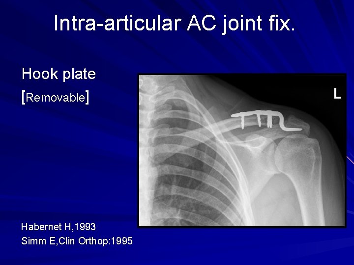 Intra-articular AC joint fix. Hook plate [Removable] Habernet H, 1993 Simm E, Clin Orthop: