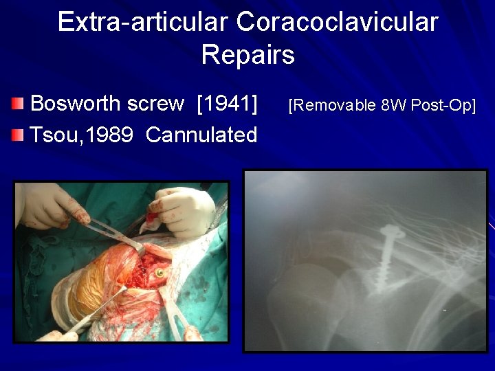 Extra-articular Coracoclavicular Repairs Bosworth screw [1941] Tsou, 1989 Cannulated [Removable 8 W Post-Op] 
