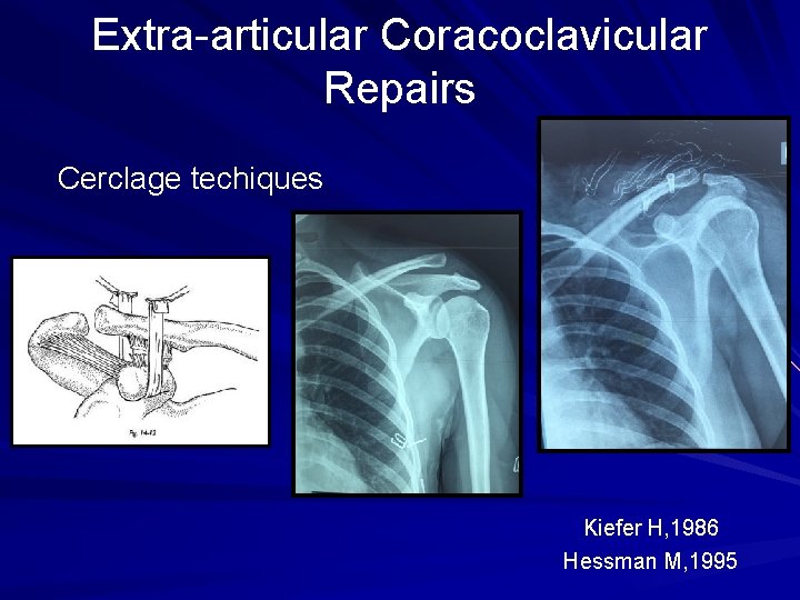 Extra-articular Coracoclavicular Repairs Cerclage techiques Kiefer H, 1986 Hessman M, 1995 