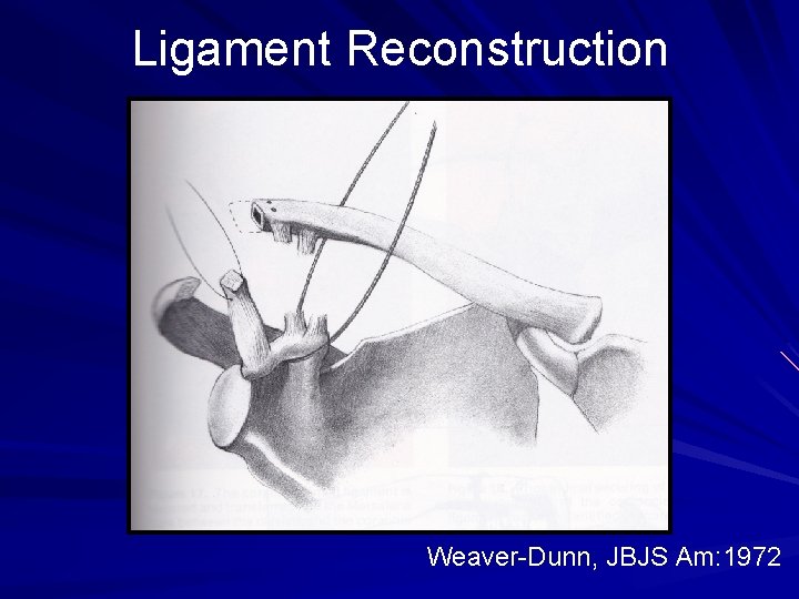 Ligament Reconstruction Weaver-Dunn, JBJS Am: 1972 