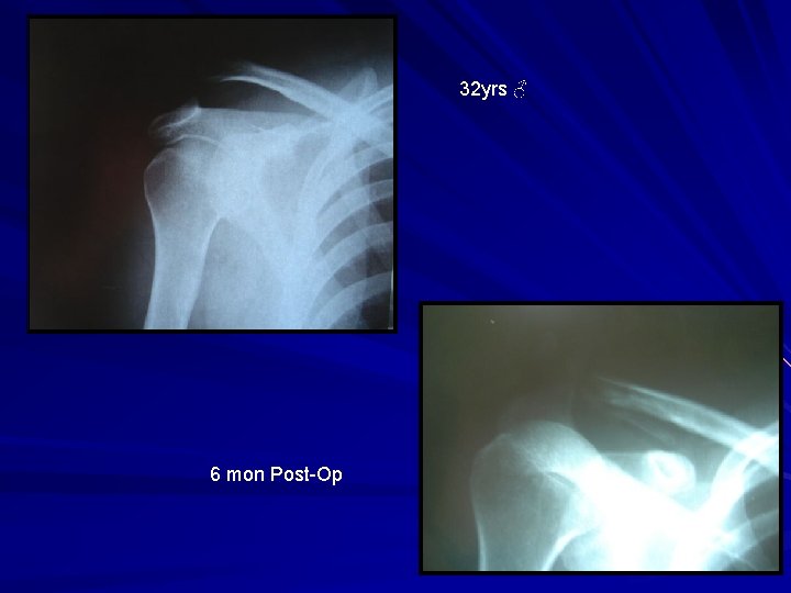 32 yrs ♂ 6 mon Post-Op 