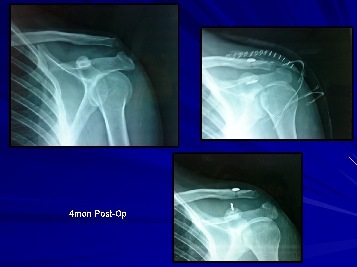 4 mon Post-Op 