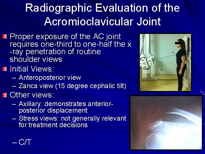 Radiographic Evaluation of the Acromioclavicular Joint Proper exposure of the AC joint requires one-third