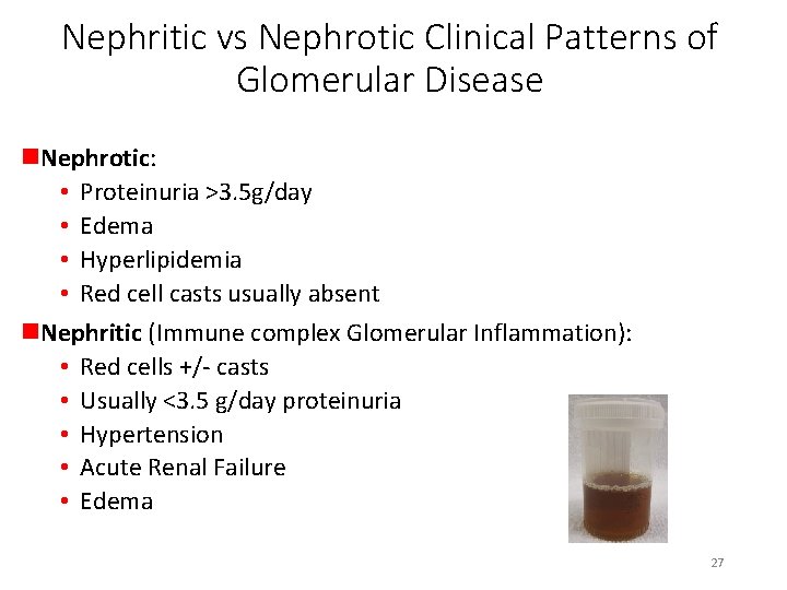 Nephritic vs Nephrotic Clinical Patterns of Glomerular Disease n. Nephrotic: • Proteinuria >3. 5