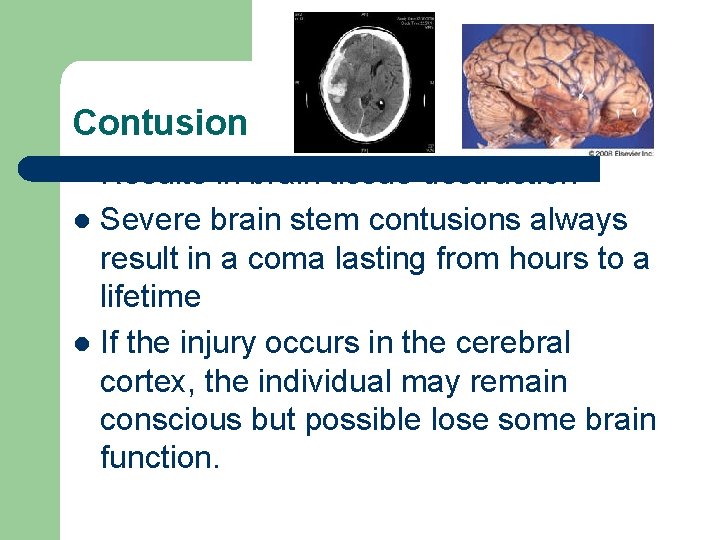 Contusion Results in brain tissue destruction l Severe brain stem contusions always result in