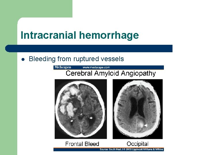 Intracranial hemorrhage l Bleeding from ruptured vessels 