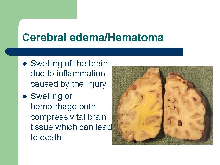 Cerebral edema/Hematoma l l Swelling of the brain due to inflammation caused by the