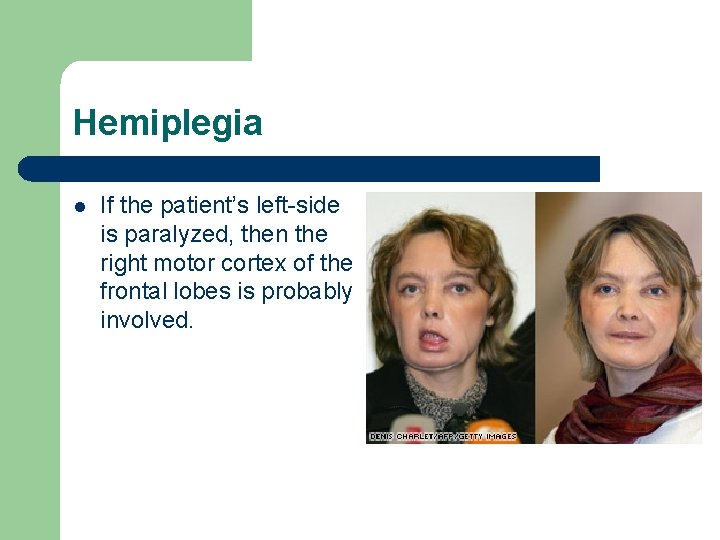 Hemiplegia l If the patient’s left-side is paralyzed, then the right motor cortex of