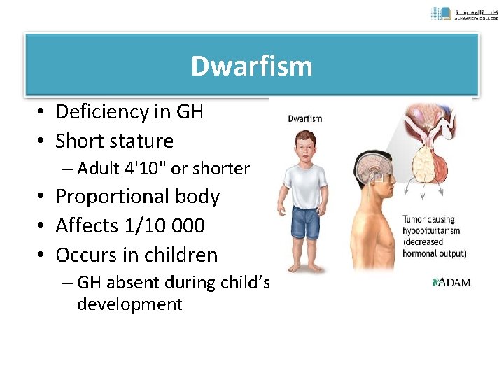 Dwarfism • Deficiency in GH • Short stature – Adult 4'10" or shorter •