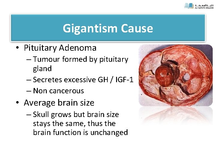 Gigantism Cause • Pituitary Adenoma – Tumour formed by pituitary gland – Secretes excessive