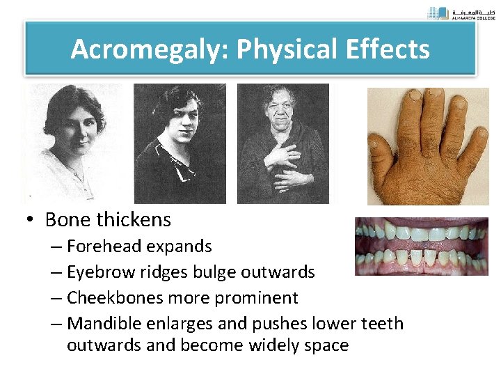 Acromegaly: Physical Effects • Bone thickens – Forehead expands – Eyebrow ridges bulge outwards