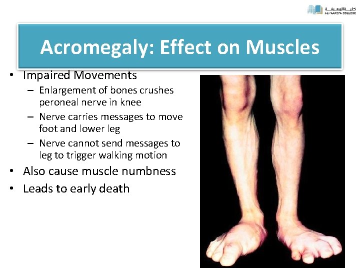 Acromegaly: Effect on Muscles • Impaired Movements – Enlargement of bones crushes peroneal nerve