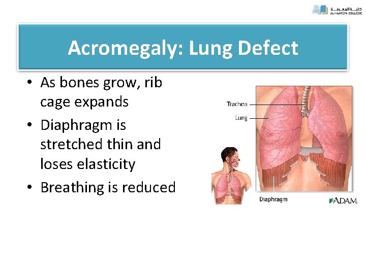 Acromegaly: Lung Defect • As bones grow, rib cage expands • Diaphragm is stretched