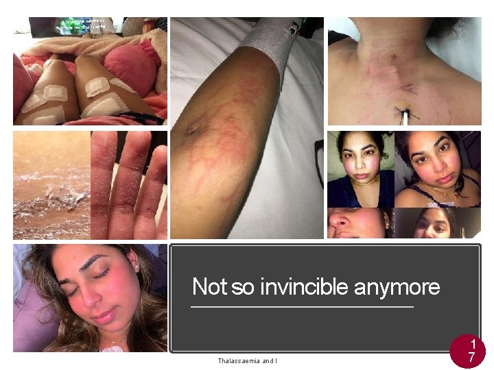 Not so invincible anymore Thalassaemia and I 1 7  Not so invincible anymore Thalassaemia and I 1 7