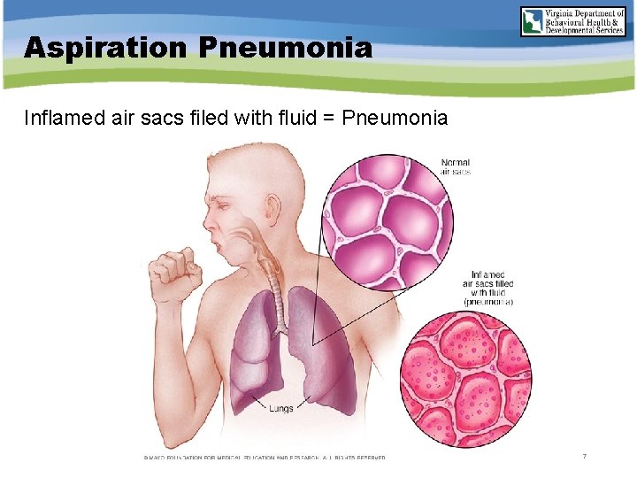 Aspiration Pneumonia Inflamed air sacs filed with fluid = Pneumonia 7 