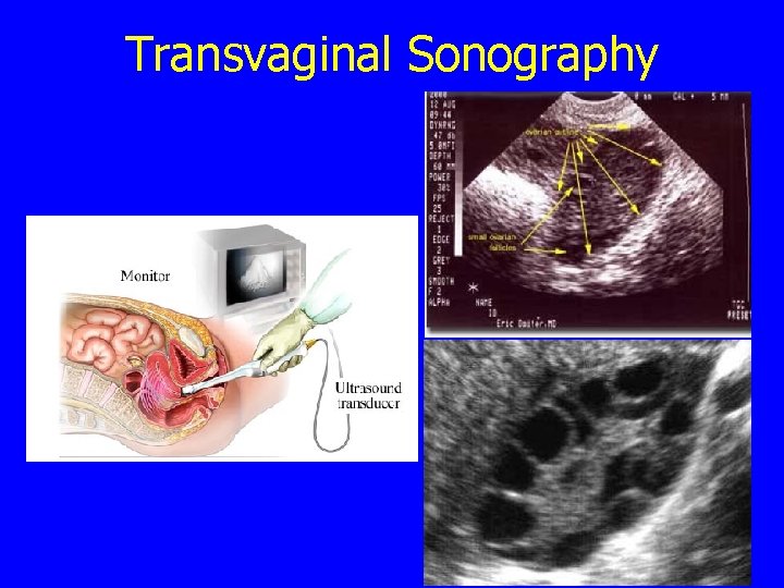 Transvaginal Sonography 