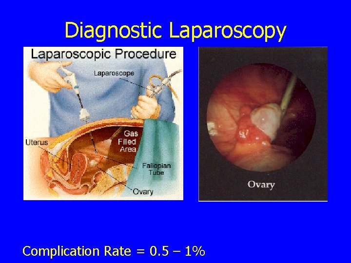 Diagnostic Laparoscopy Complication Rate = 0. 5 – 1% 