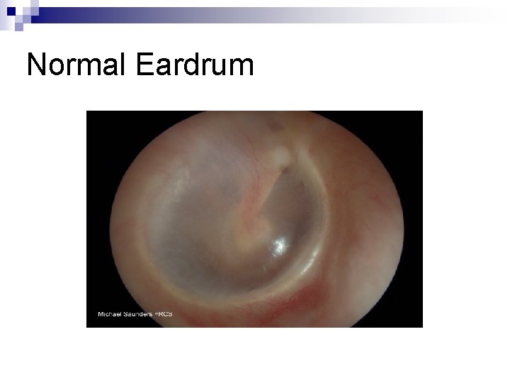Normal Eardrum 