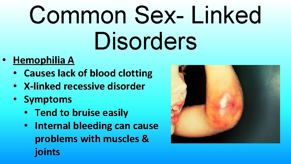 Common Sex- Linked Disorders • Hemophilia A • Causes lack of blood clotting •