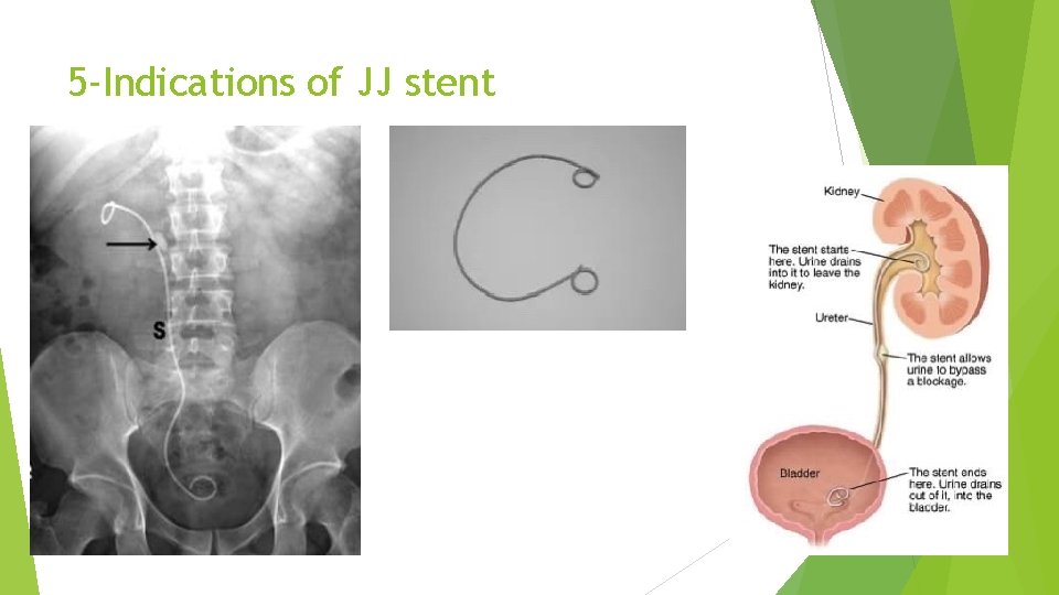 5 -Indications of JJ stent 