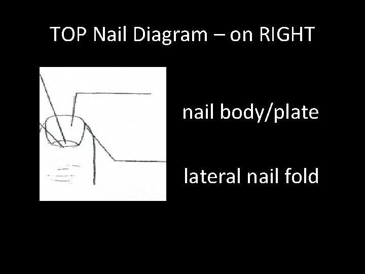 TOP Nail Diagram – on RIGHT nail body/plateral nail fold 