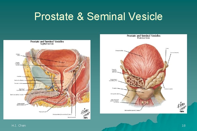 Prostate & Seminal Vesicle H. I. Chen 18 