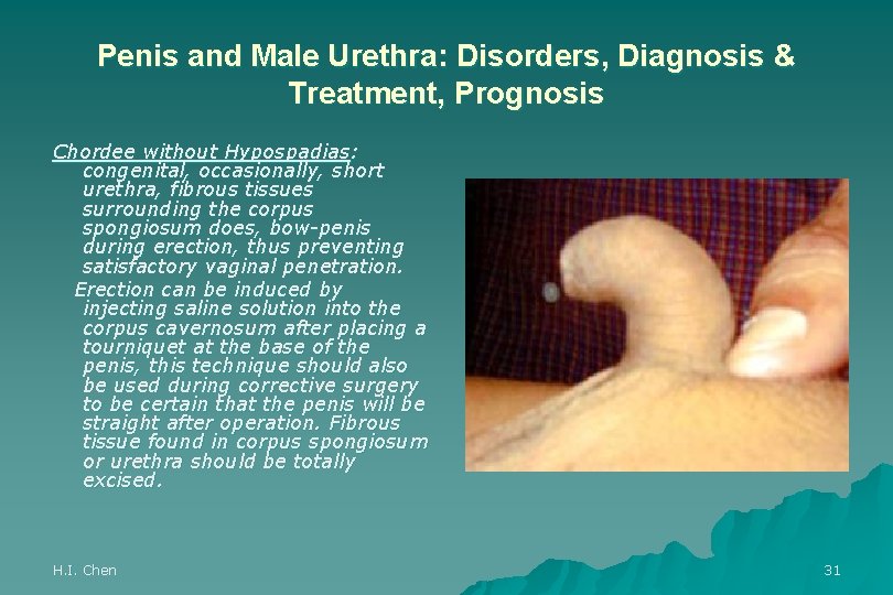 Penis and Male Urethra: Disorders, Diagnosis & Treatment, Prognosis Chordee without Hypospadias: congenital, occasionally,
