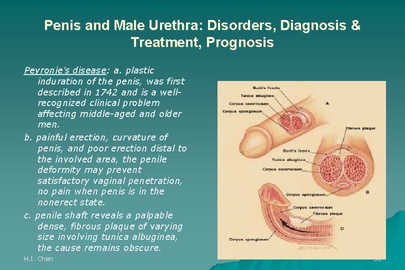 Penis and Male Urethra: Disorders, Diagnosis & Treatment, Prognosis Peyronie’s disease: a. plastic induration