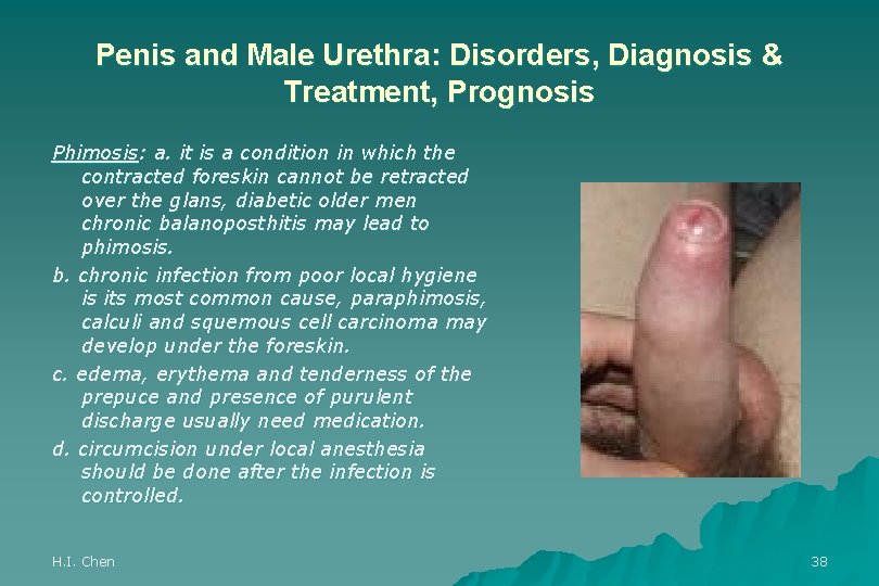 Penis and Male Urethra: Disorders, Diagnosis & Treatment, Prognosis Phimosis: a. it is a