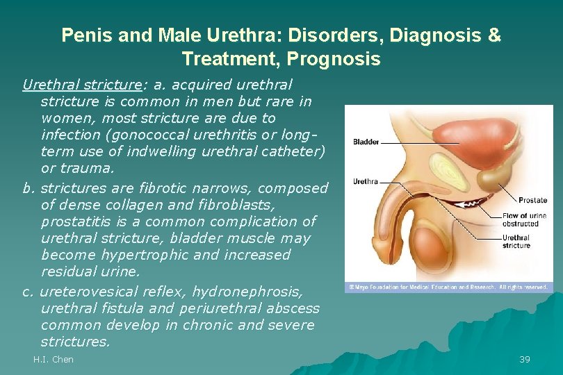 Penis and Male Urethra: Disorders, Diagnosis & Treatment, Prognosis Urethral stricture: a. acquired urethral