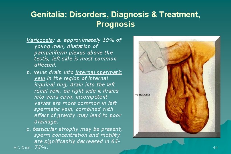 Genitalia: Disorders, Diagnosis & Treatment, Prognosis Varicocele: a. approximately 10% of young men, dilatation