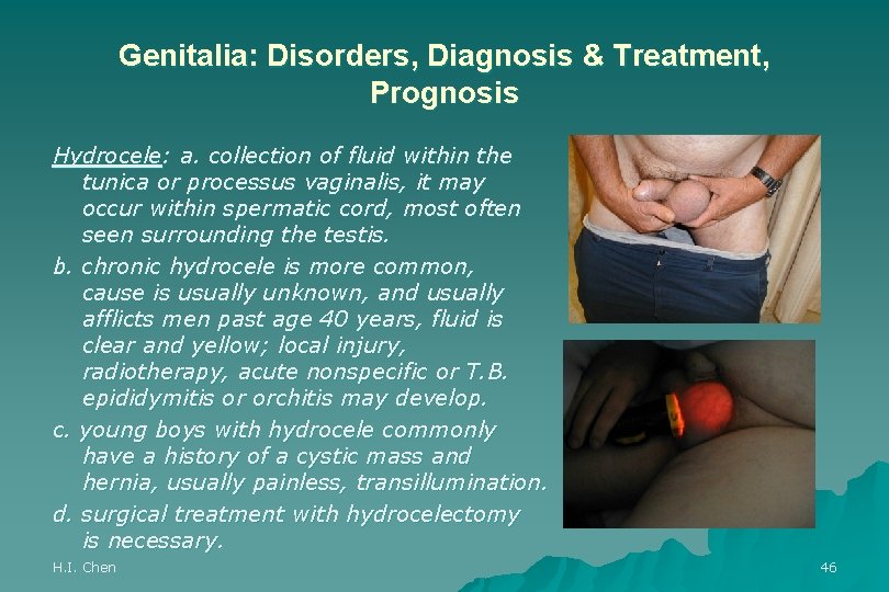 Genitalia: Disorders, Diagnosis & Treatment, Prognosis Hydrocele: a. collection of fluid within the tunica