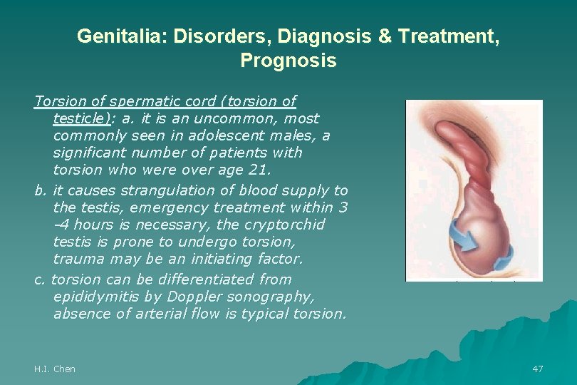 Genitalia: Disorders, Diagnosis & Treatment, Prognosis Torsion of spermatic cord (torsion of testicle): a.
