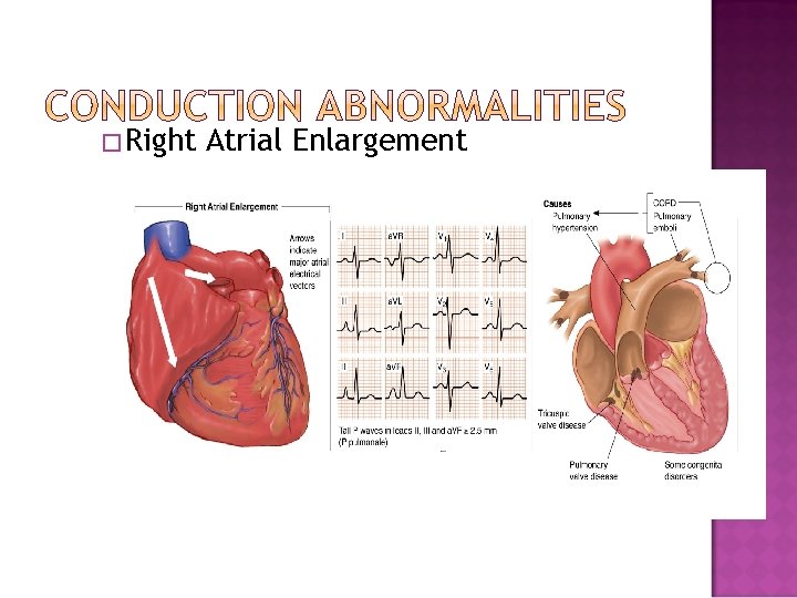 �Right Atrial Enlargement 