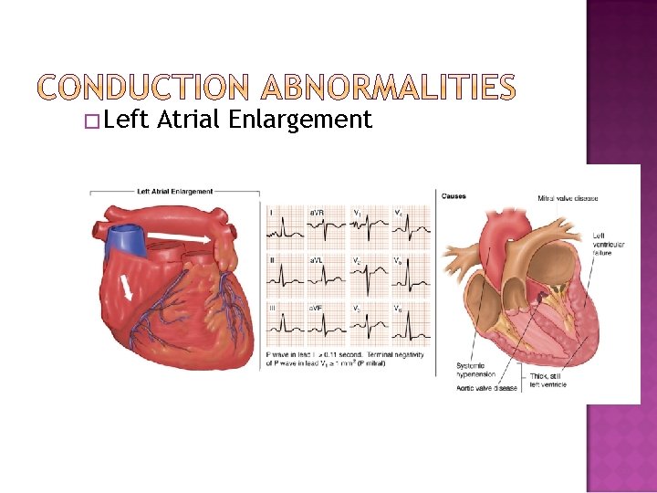 �Left Atrial Enlargement 